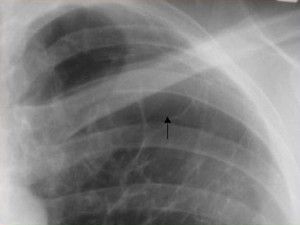 bulla_cxr_pa